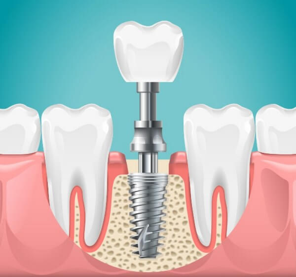 best dental implants in Surat
