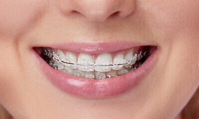 orthodontic braces dentists in Surat