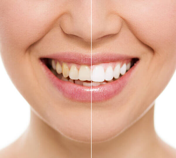 Best Teeth whitening treatment in Gujarat