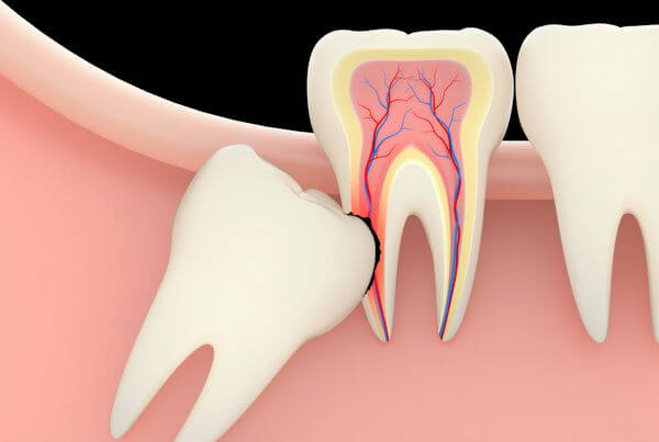 best dentists for wisdom teeth removal in Surat