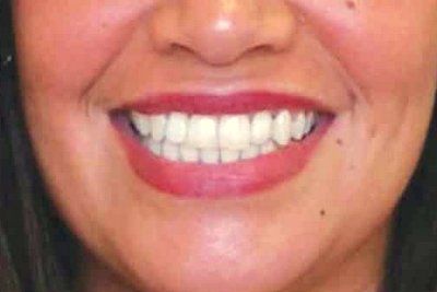 before-after full mouth dental implants in Surat