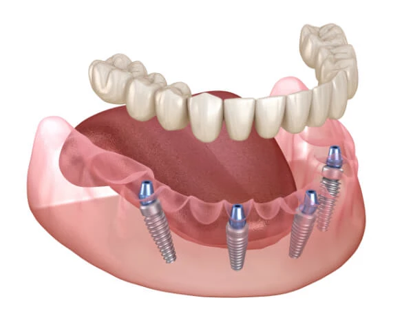 A detailed view of All-on-4 implants supporting a full denture, highlighting the benefits of all-on-4 dental implants.