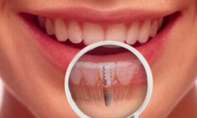 Full Mouth Dental implants in Gujarat