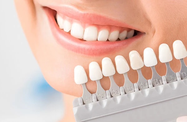 Close-up of matching dental veneers crafted by a skilled teeth veneers dentist.