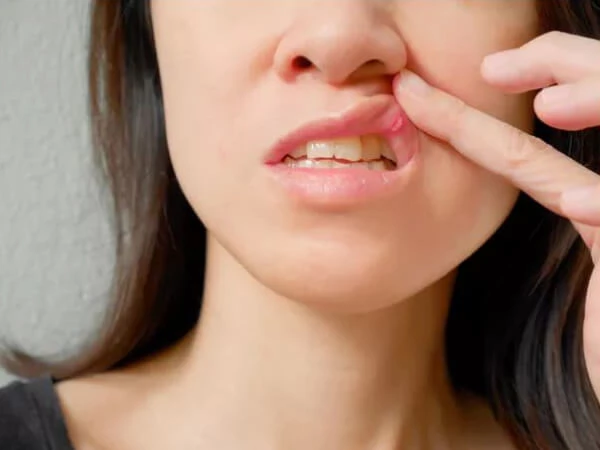 mouth ulcer dentist in Gujarat