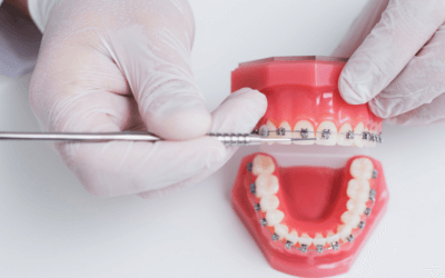 Best Orthodontic Braces for dental problems