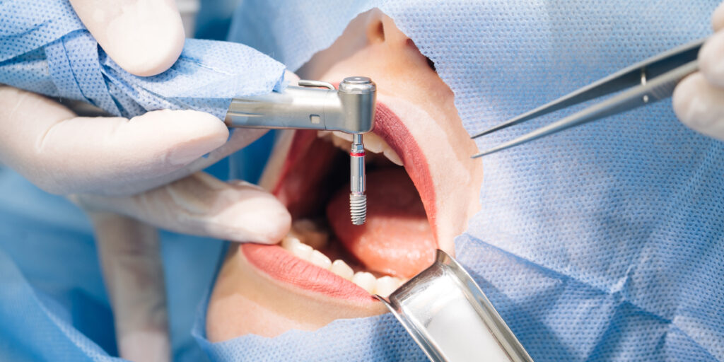 full mouth dental implants in Surat