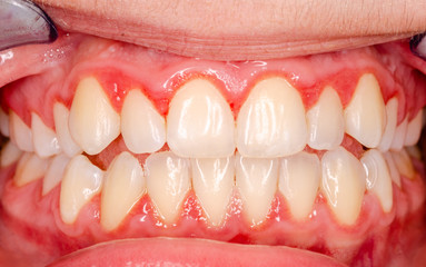 gum diseases