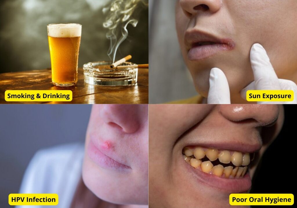 causes of lip cancer