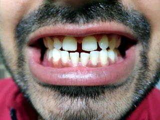 Close the gaps between your teeth with invisible braces in Gujarat