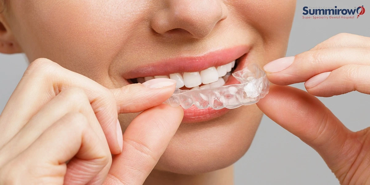 How Customised Invisible Braces Can Fix Misalignment of Your Teeth