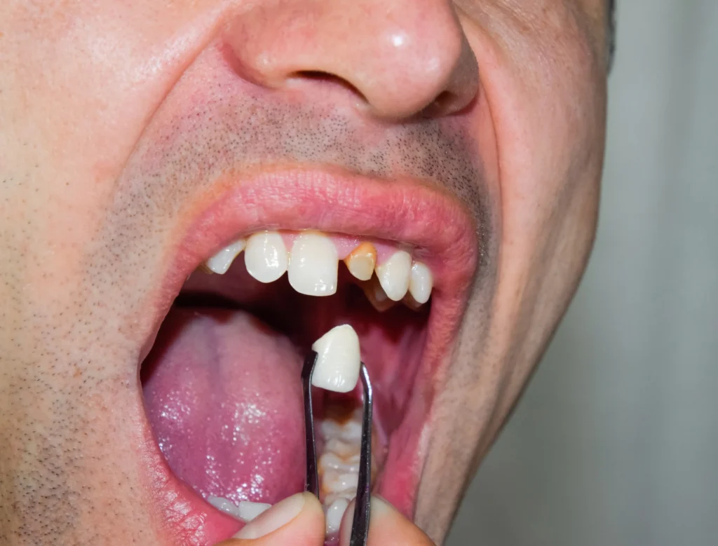 Side Effects of consumption of tobacco and smoke Oral Cancer Affect Teeth