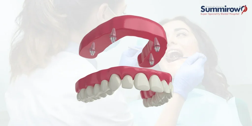 How Full Mouth Dental Implants Plays a Role in Reshaping Oral Health