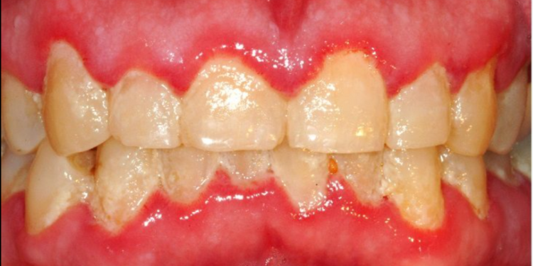 Gum therapy treatment to prevent monsoon-related gum infections