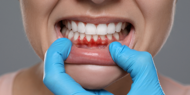 Close-up of swollen and bleeding gums during monsoon season - highlighting the need for Monsoon Dental Care, deep cleaning, and gum therapy treatment.