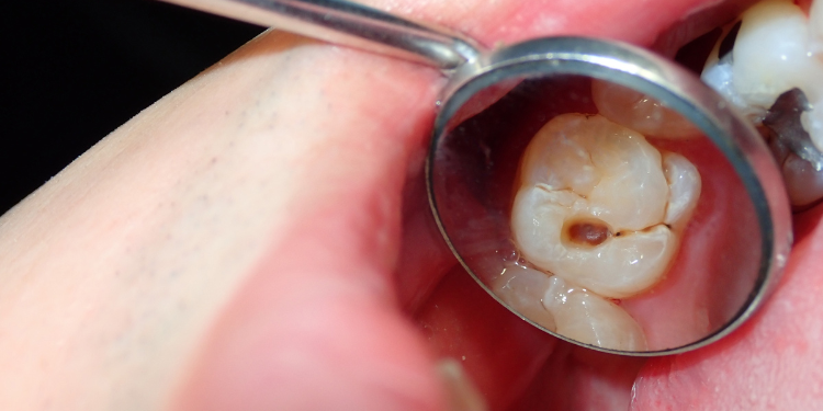 Root Canal vs Extraction comparison showing treatment differences