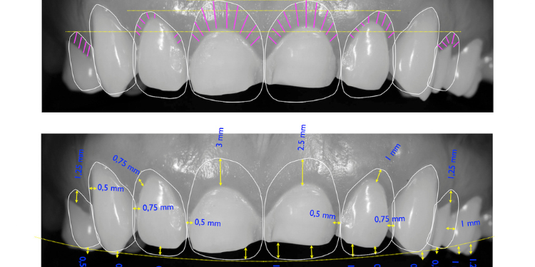 Digital Smile Design analysis showing teeth measurements, alignment, proportions, and gum contouring for Smile Design for Diwali makeover.