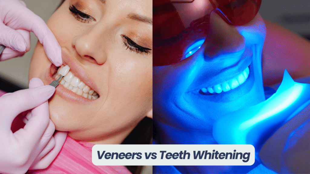Veneers vs Teeth Whitening comparison 2025 cosmetic dentistry