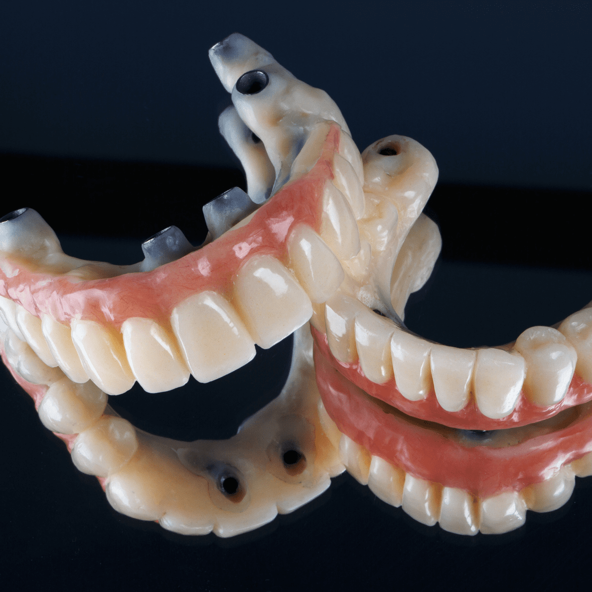 All On 4 & All On 6 Dental Implants