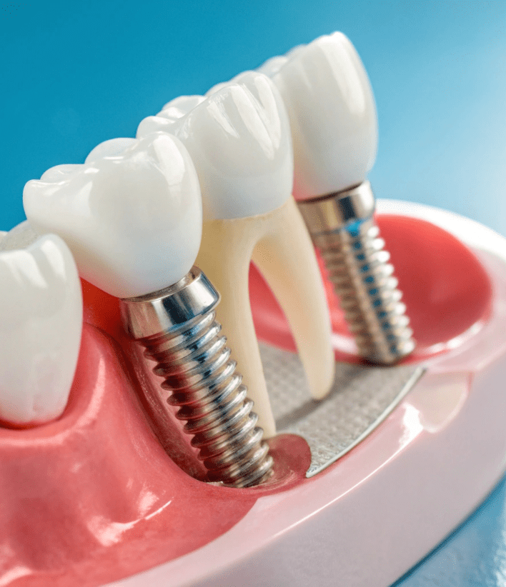 All-on-6 Dental Implants