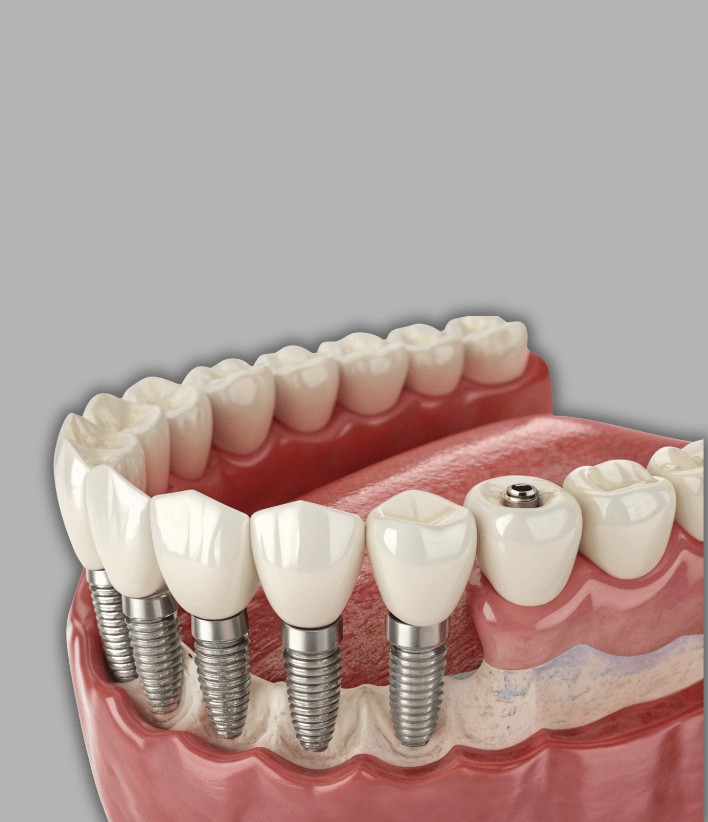 Best All-on-4 & All-on-6 Dental Implants
