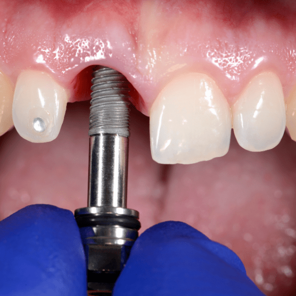 Best Immidiate dental implant in surat