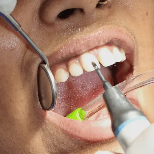 Best dental scaling treatment in Surat