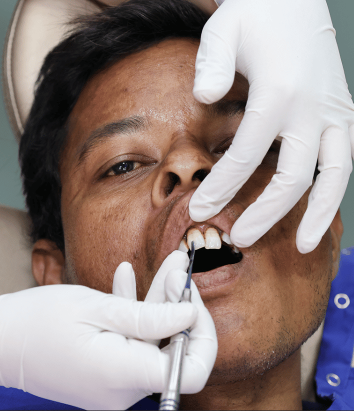 Cavity filling in Surat