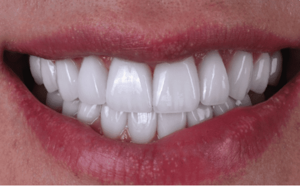 Ceramic veneer After