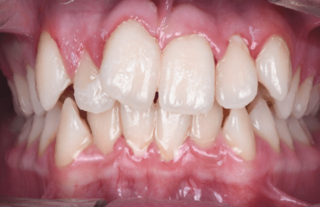 Dental Braces before