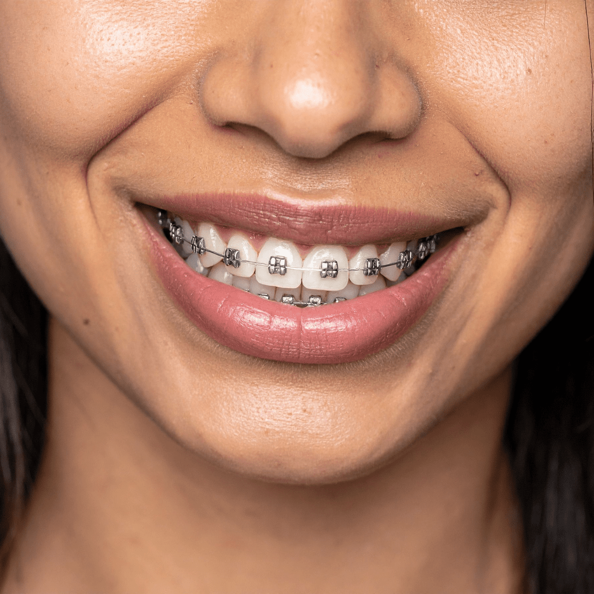 Dental Braces