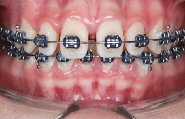 Dental Braces-before