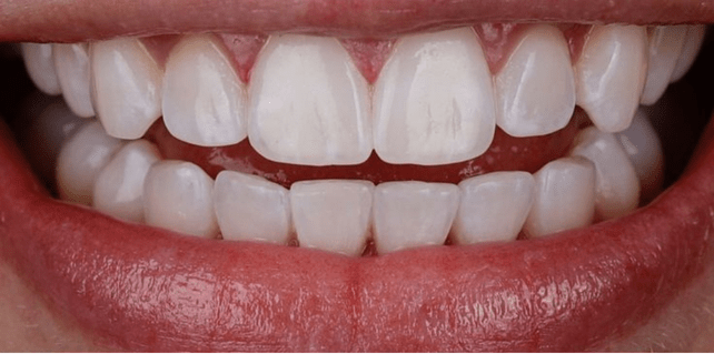 Dental Braces-after