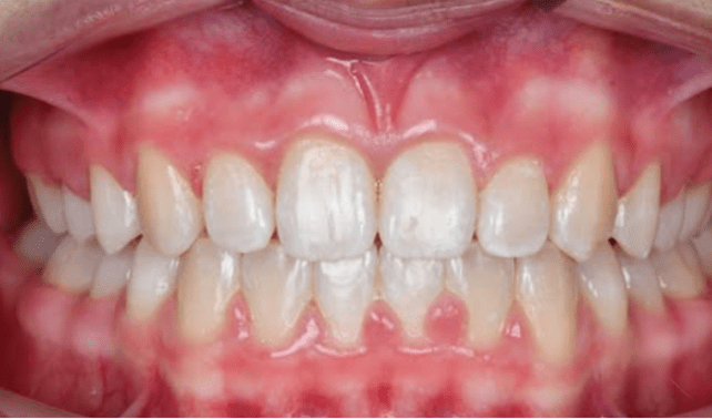 Dental Braces-After