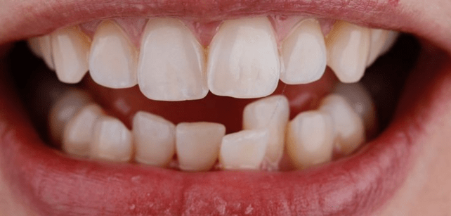 Dental Braces-before