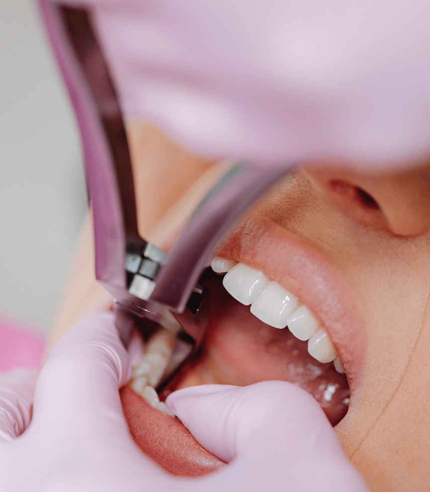 Dental Extraction (1)