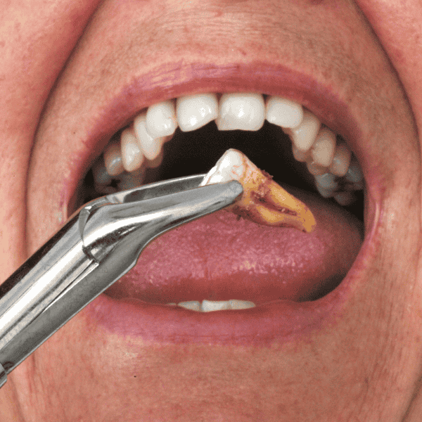 Dental Extraction-1