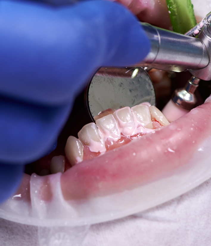 Dental Scaling And Polishing
