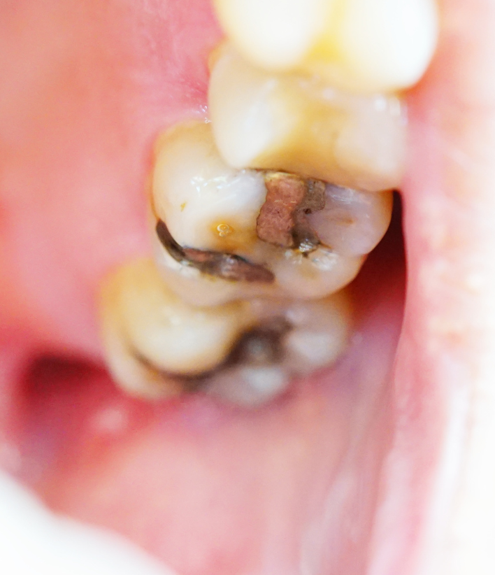Dental fillings-2
