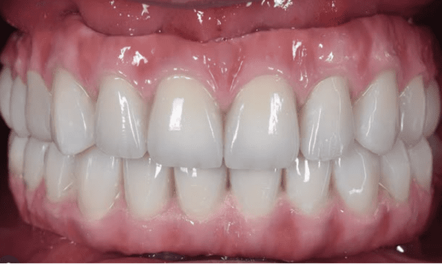Dental implant After 1