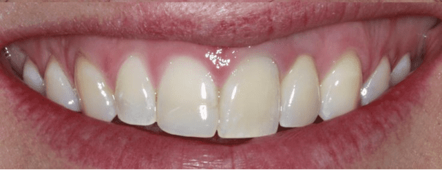 Dental implant After 2