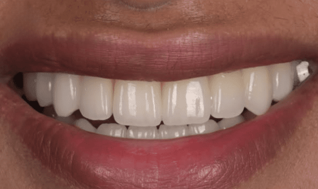 Dental implant After