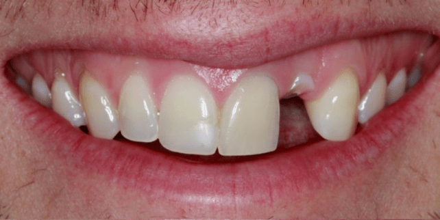 Dental implant before 2