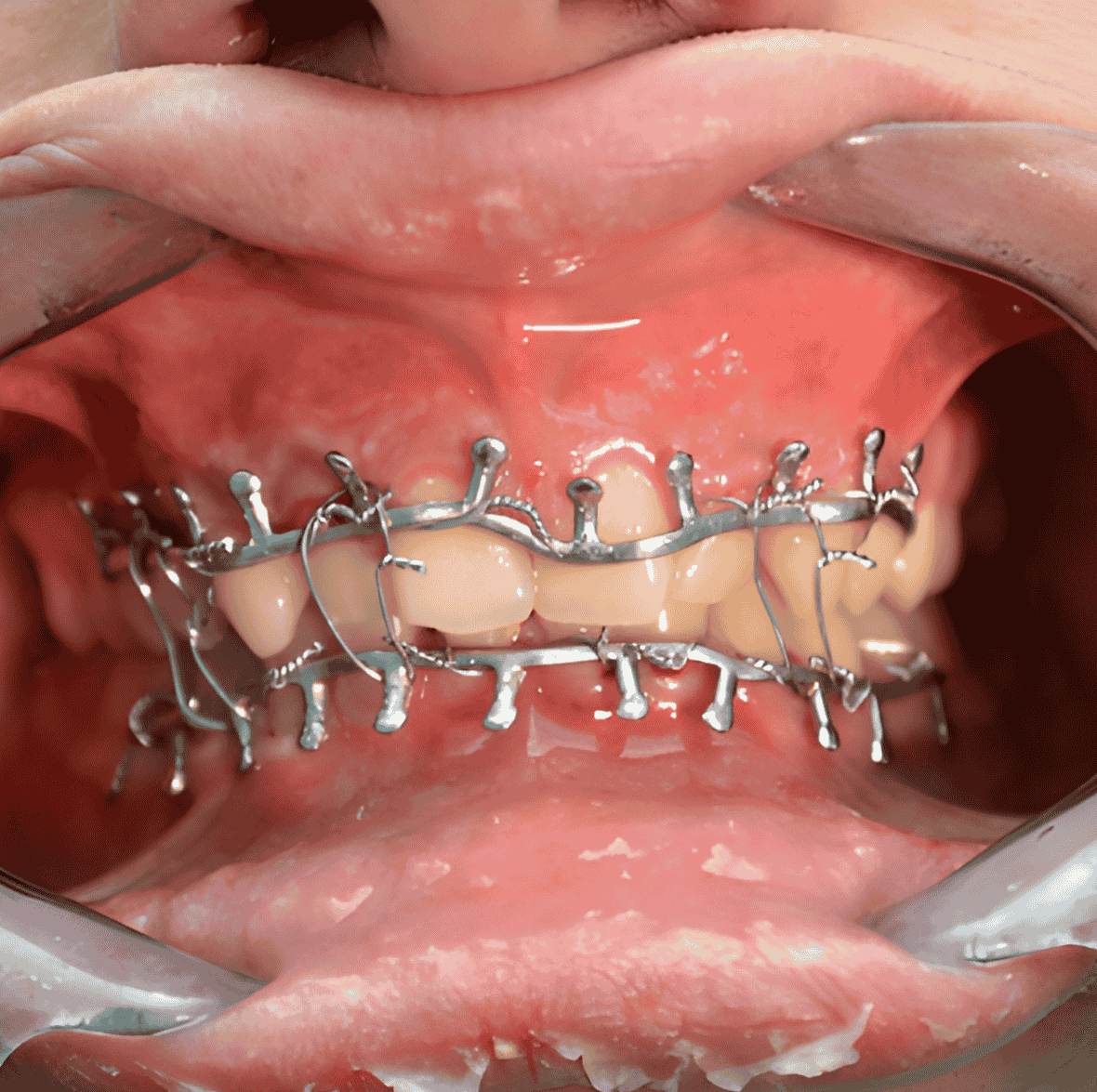 Facial Injuries and Dental Trauma