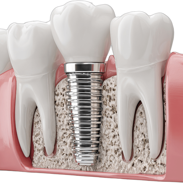 Immidiate dental implant in surat