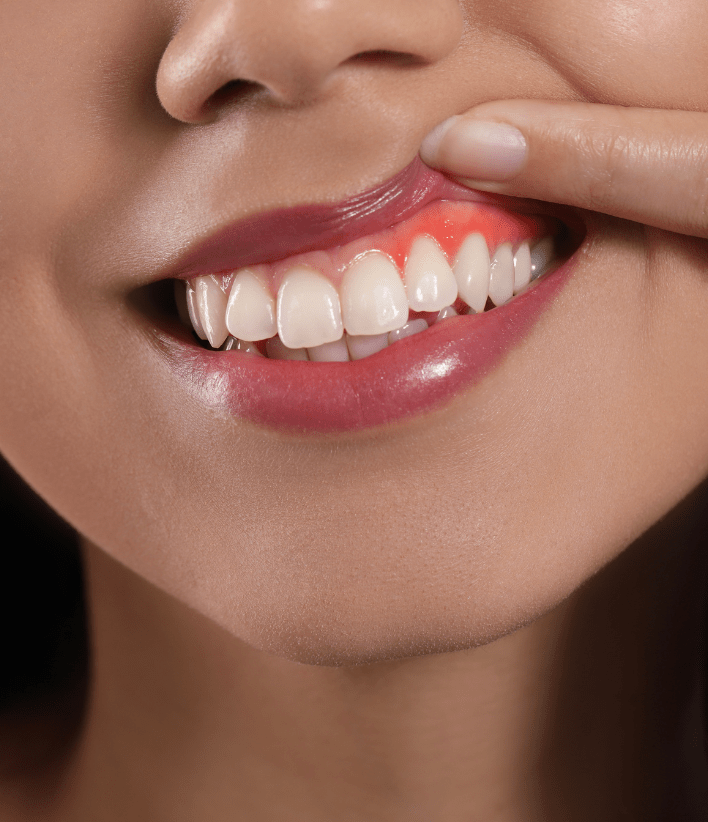 Laser dentistry in surat