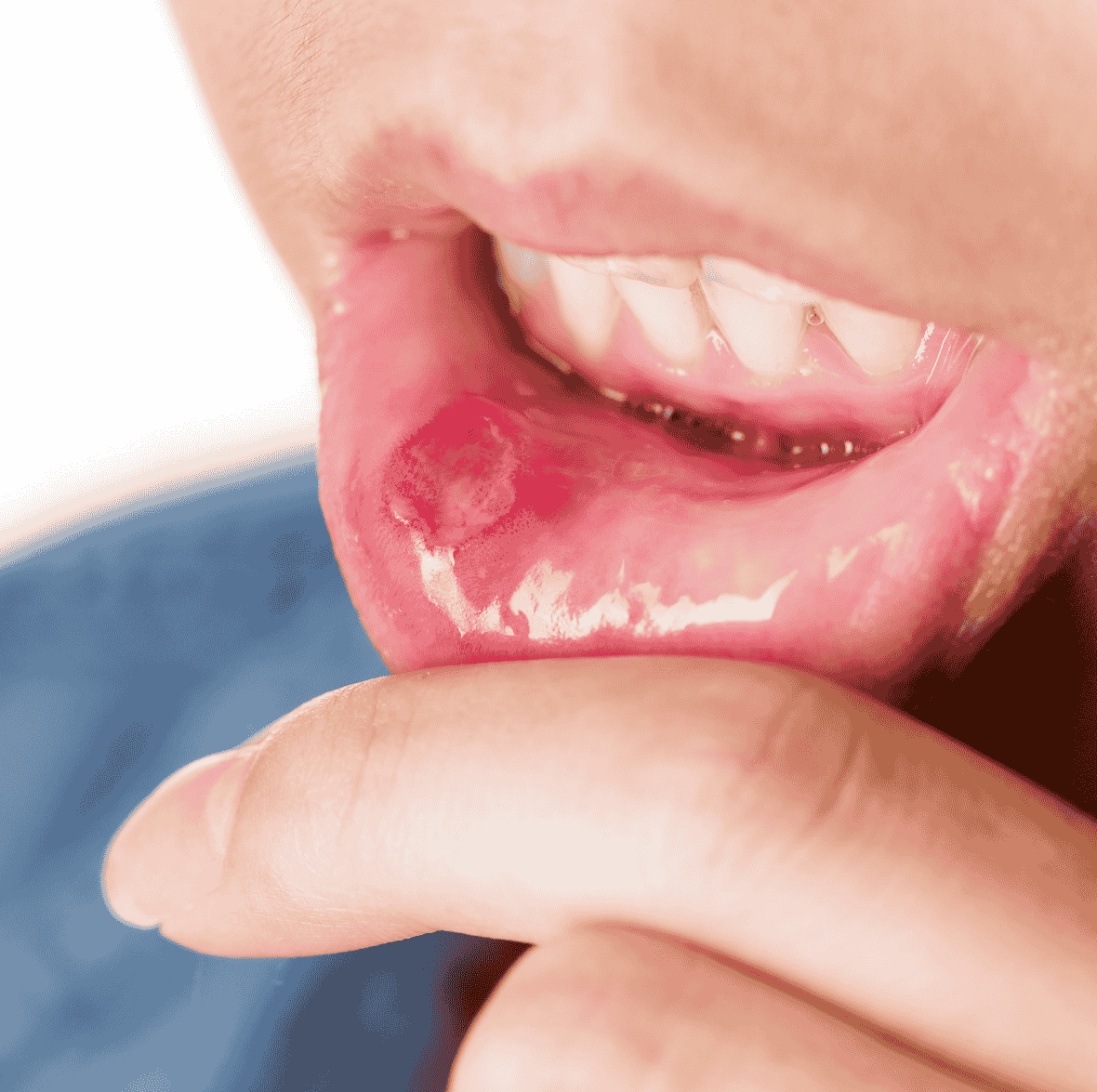 Oral Ulcers