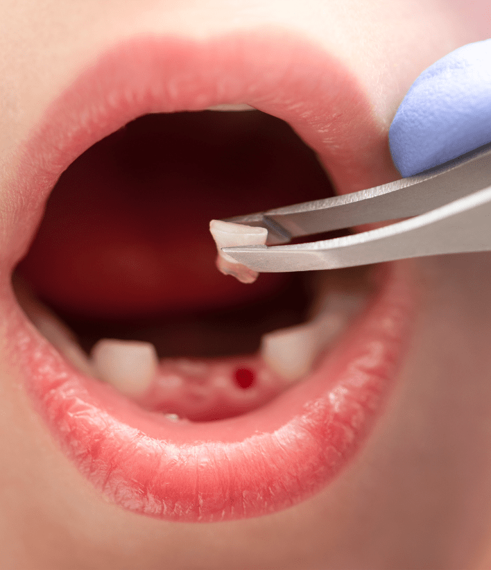 Pediatric tooth extraction-4