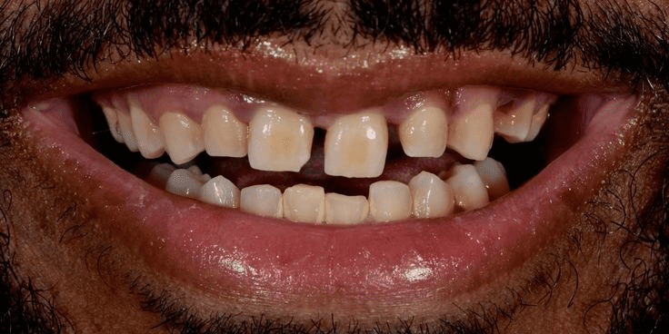 Porcelain veneer makeover to close gaps and enhance overall smile-before