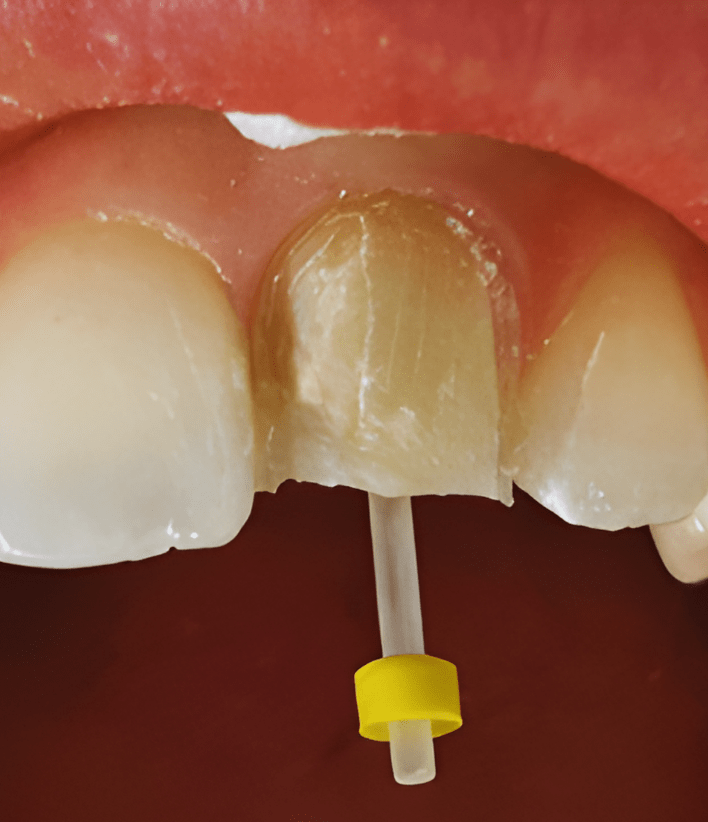 Post and Core Buildup-2